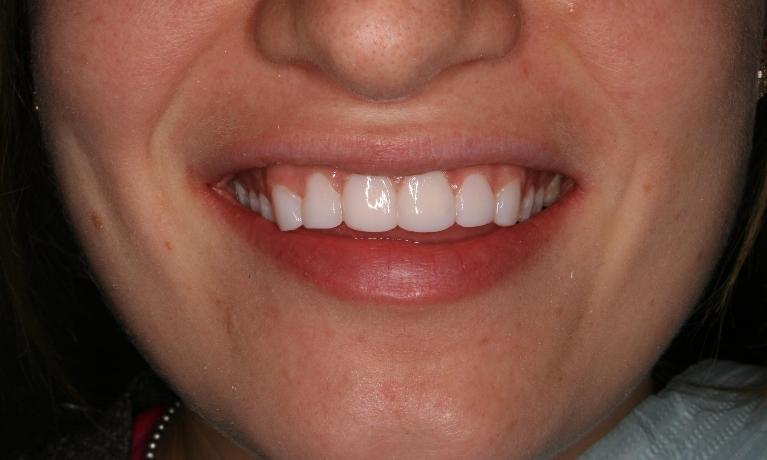 Cosmetic-Bonding-After-Image