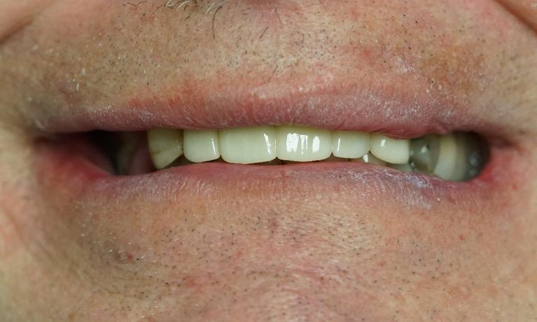 Front-Implant-Bridge-After-Image