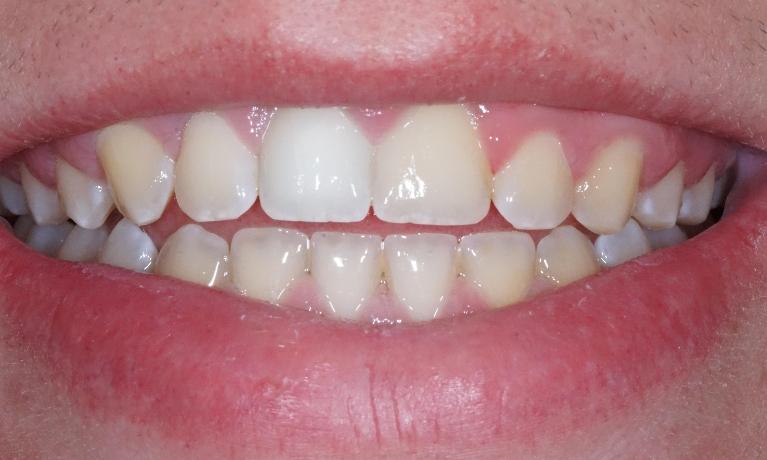 Internal-Bleaching-After-Image