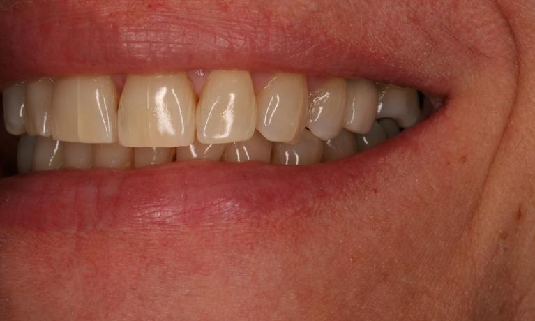 Single-Implant-After-Image