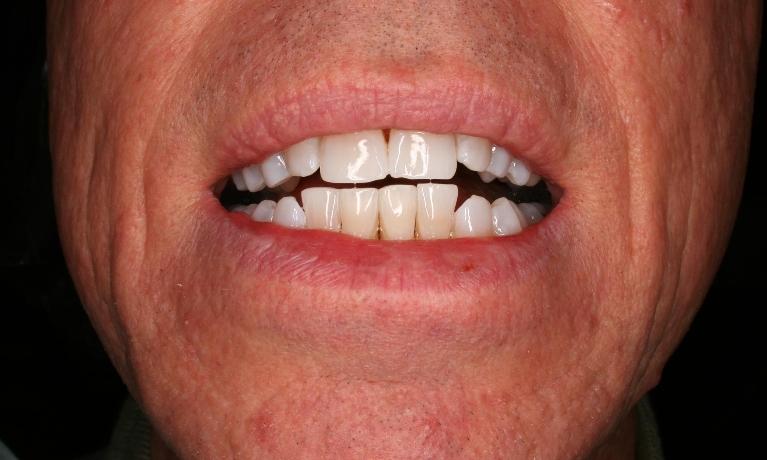 Teeth-Whitening-After-Image