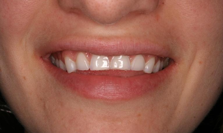 Cosmetic-Bonding-Before-Image