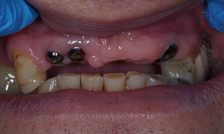 Front-Implant-Bridge-Before-Image