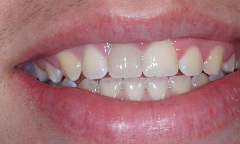 Internal-Bleaching-Before-Image