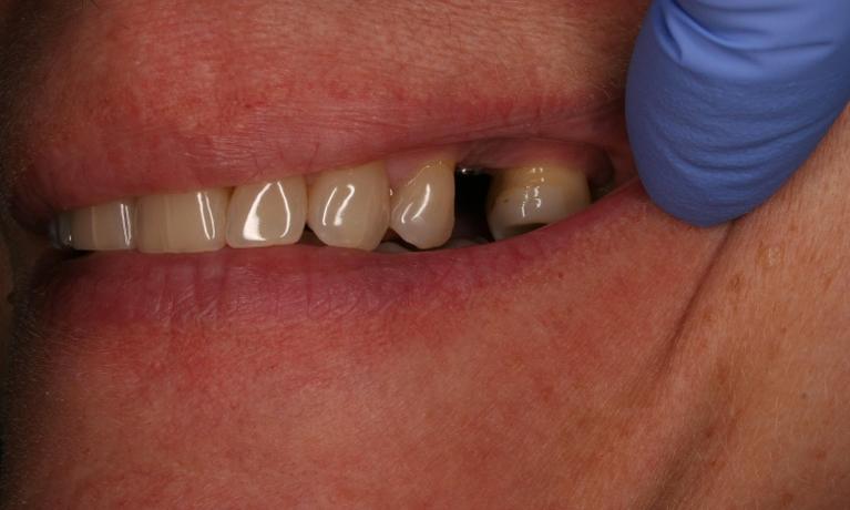 Single-Implant-Before-Image